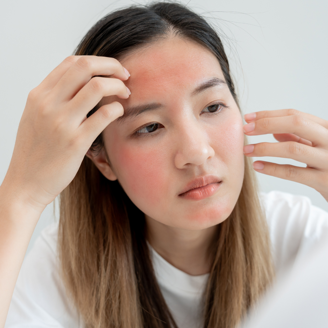 Rosacea